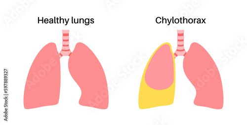 Chylothorax anatomical poster