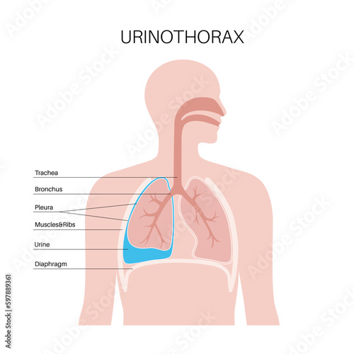Urinothorax anatomical poster