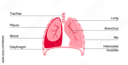 Hemothorax medical poster