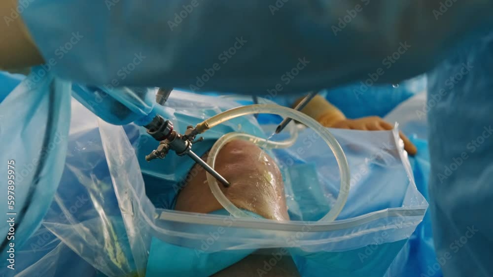 Stockvideo The surgeon performs endoscopic manipulation on the kneecap