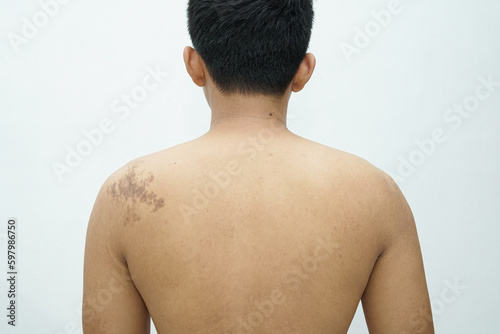 An Asian man showing a birthmark freckles on his left back photo