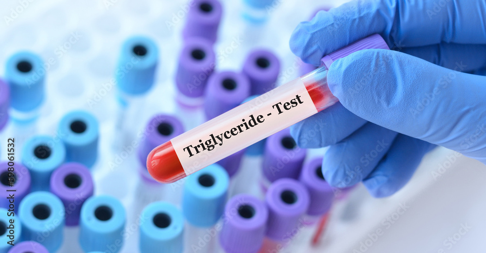 Obraz premium Doctor holding a test blood sample tube with Triglyceride test on the background of medical test tubes with analyzes
