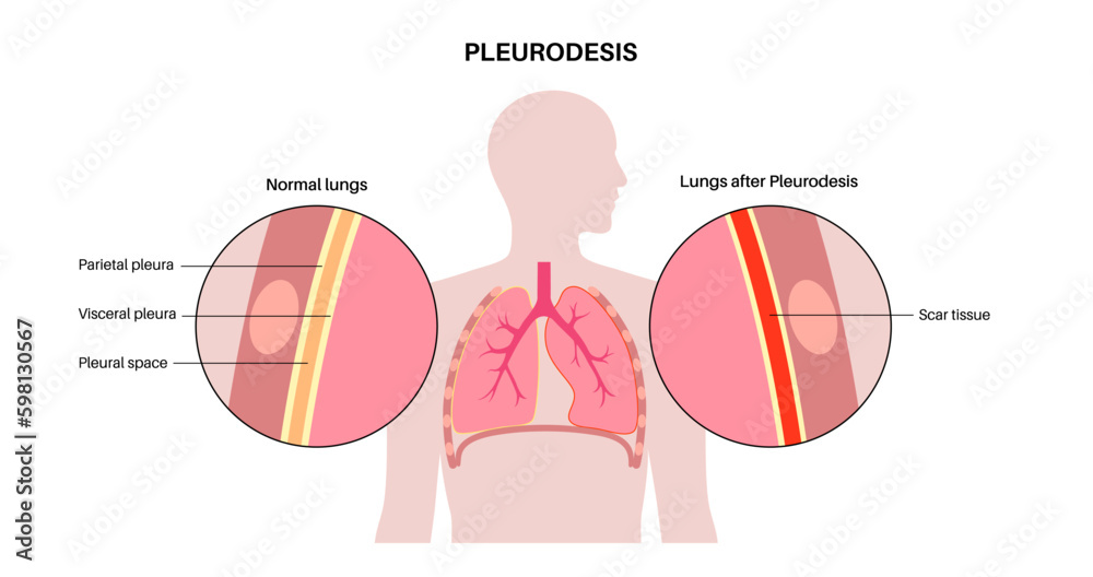 Fototapeta premium Pleurodesis medical procedure Generative AI