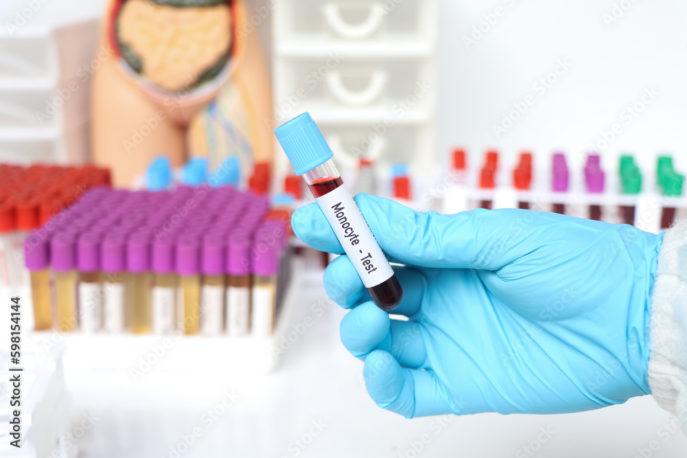 Monocyte test, blood sample to analyze in the laboratory Monocyte test, blood sample to analyze in the laboratory