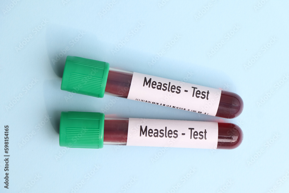 Measles test, blood sample to analyze in the laboratory Measles test, blood sample to analyze in the laboratory