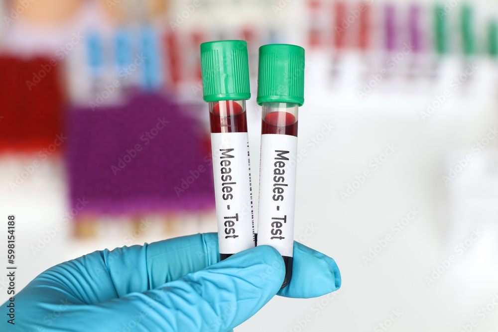 Measles test, blood sample to analyze in the laboratory