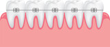 teeth braces illustration. Dental care teeth concept.