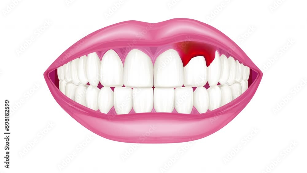 健康な歯ぐきが腫れる症状のイラスト動画