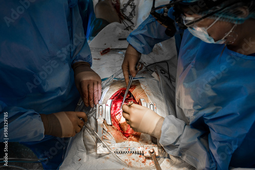 Fotografía Close up of open heart surgery cardiopulmonary bypass, minimal invasive cardiac surgery, cannulation techniques