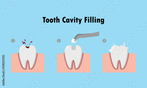 Step of restoring cavity tooth by filling tooth illustration cartoon character vector design on blue background. Dental care concept.