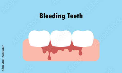 Bleeding White teeth while cleaning because brushing with toothbrush illustration cartoon character vector design on blue background. Dental care concept.