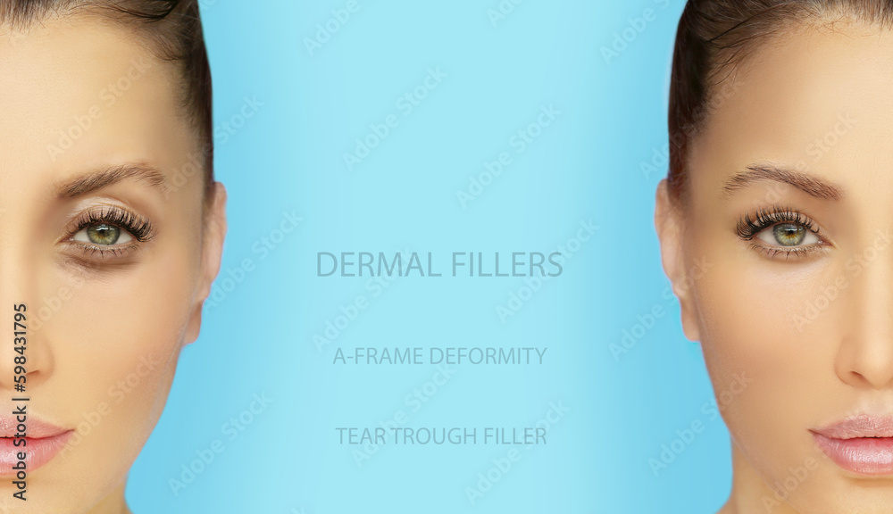 Tear Trough Filler,Aframe deformity. Fat grafting or dermal filler