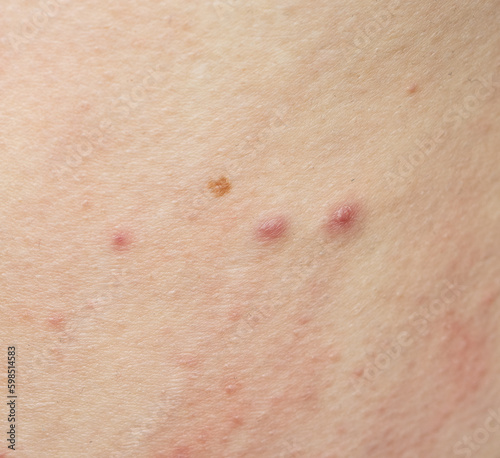 Tablou pe pânză insect bite on skin as background.