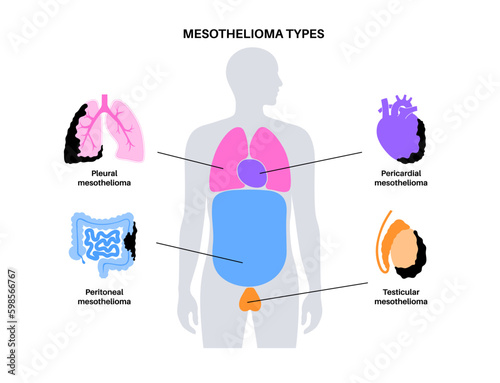 Mesothelioma tumor types Generative AI