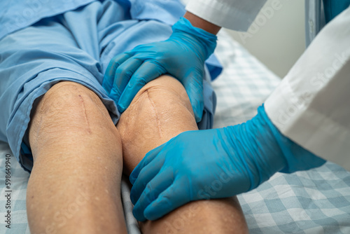 Asian elderly woman patient show her scars surgical total knee joint replacement Suture wound surgery arthroplasty on bed in nursing hospital ward, healthy strong medical concept.