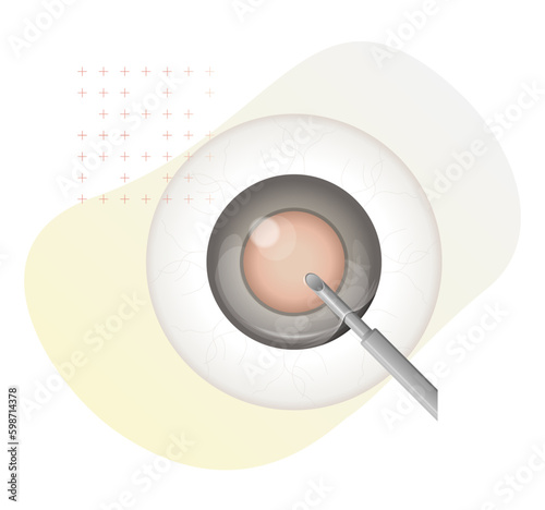 Human Eye - Cataract Procedure - Illustration