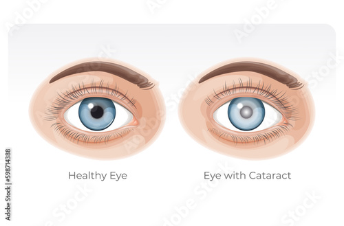 Human Healthy Eye and Eye with Cataract - Illustration