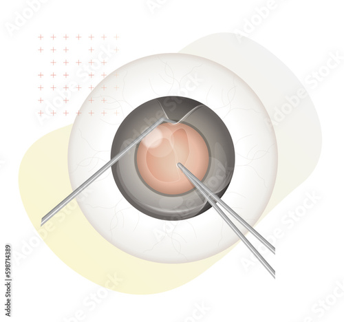 Human Eye - Cataract Procedure - Illustration