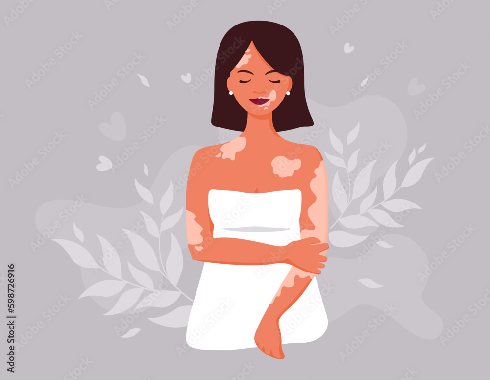 World Vitiligo Day. Another kind of beauty. Love yourself, accept your body. Body positive and self acceptance. Vector illustration World Vitiligo Day. Another kind of beauty. Love yourself, accept your body. Body positive and self acceptance. Vector illustration