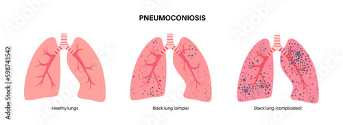 Coal workers disease Generative AI