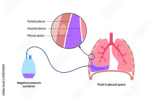 Tunneled pleural catheter Generative AI