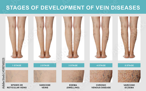Stages of development of vein diseases. Photos of woman and zoomed skin area, closeup. Collage design showing varicose veins, edema and other phases photo