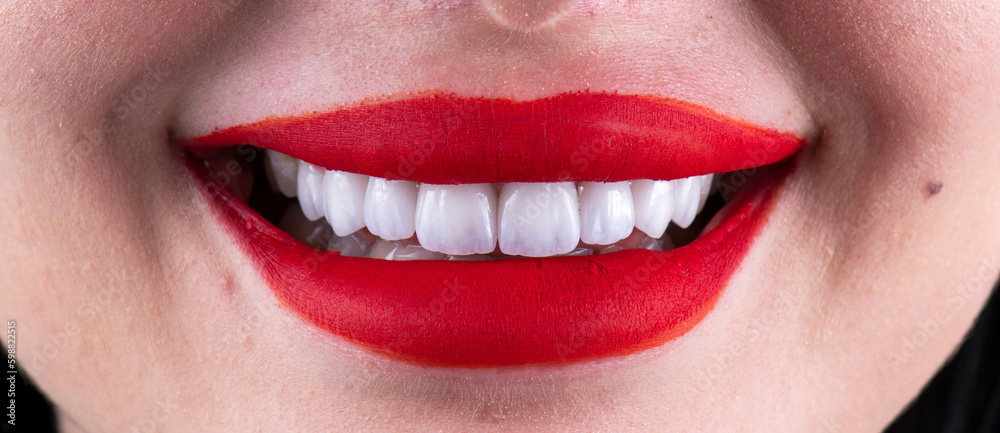 max crowns and veneers max crowns and veneers