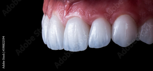 Obraz na płótnie max crowns and veneers