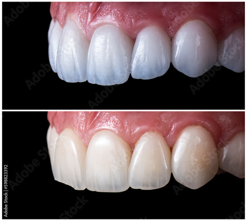 max crowns and veneers