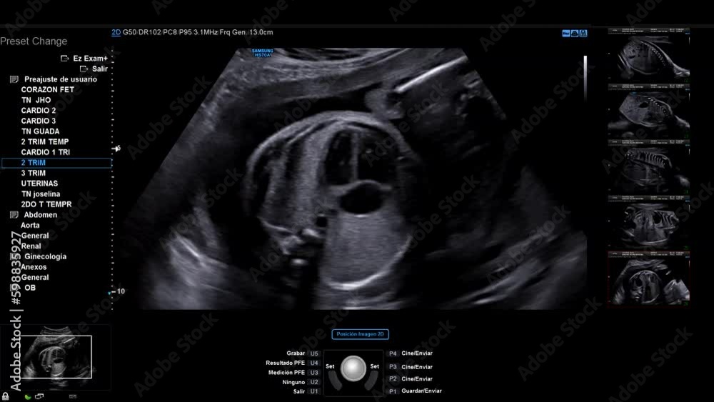 Ecografia de un bebe en gestacion en donde se observa su corazon latiendo, con las palabras del sistema del aparato ecografo en español