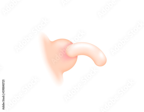 illustration of an acne bump that secrete pus fluid. a blackhead come out of the skin. abscess. 3d and realistic illustrations. vector elements