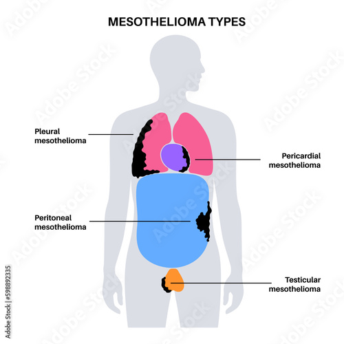 Mesothelioma tumor types Generative AI