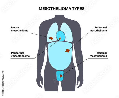 Mesothelioma tumor types Generative AI