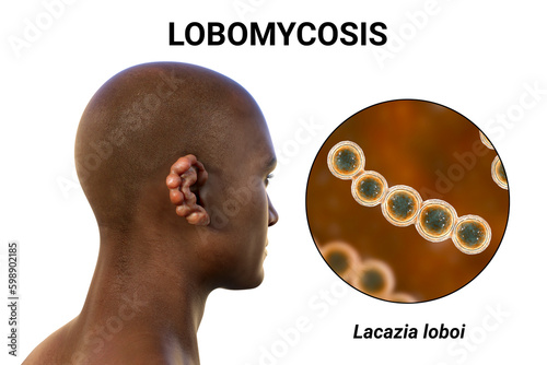 Lobomycosis, a chronic skin disease caused by microscopic fungi Lacazia loboi and characterized by nodular skin lesions, 3D illustration photo