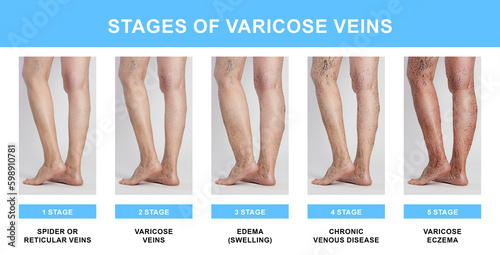 Stages of varicose veins. Collage with photos of woman showing changes during different phases, closeup of legs photo