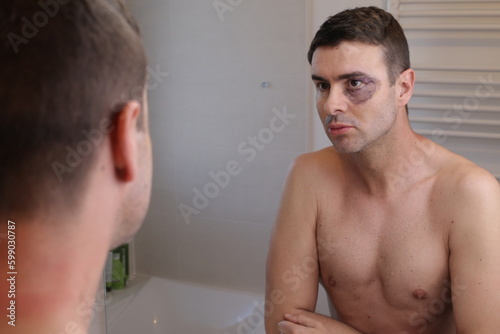 Man with a bruised eye contemplating his mirror reflection 