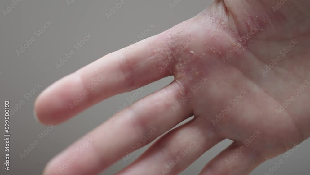 closeup dry cracked skin palm hand inflammation psoriasis dermatitis