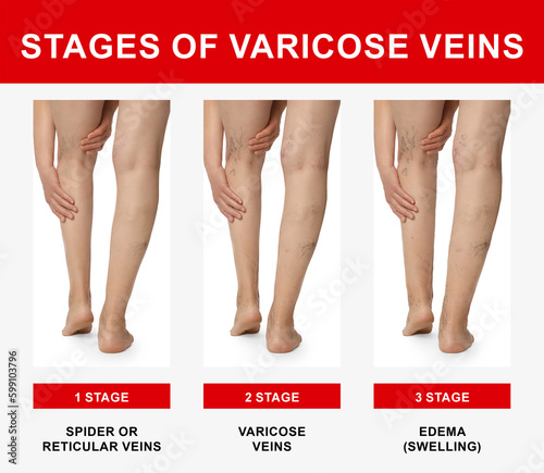 Stages of varicose veins. Collage with photos of woman showing changes during different phases, closeup of legs