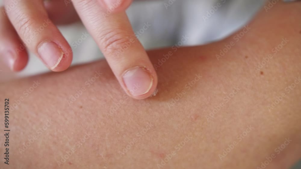 Person swab a skin disease with an ointment. Shingles, Disease, Herpes zoster, varicellaz