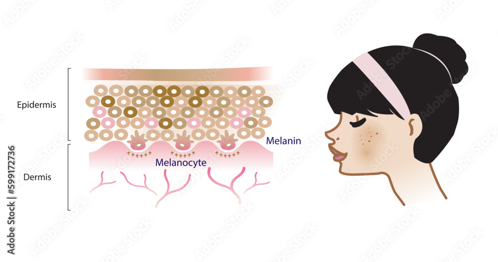 The mechanism of melasma skin vector on white background. Infographic ...