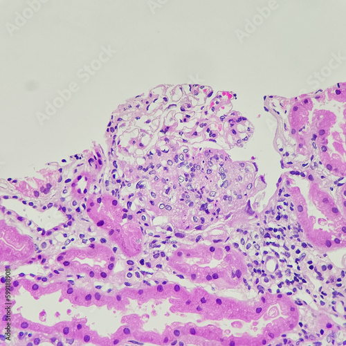 Cameras photo of segmental endocapillary hypercellularity in case of lupus nephritis, magnification 400x, photograph through a microscope