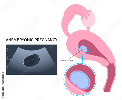 Ectopic pregnancy Blighted ovum of anembryonic loss missed abortion empty egg molar conception fertilization miscarriage and early first Natural photo