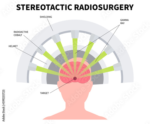 Central nervous system disease Radiosurgery X-ray and MRI imaging scan Gamma tumor cancer treat exam body medicine focus accelerator beam of CT Linac linear particle Knife minimally invasive oncology