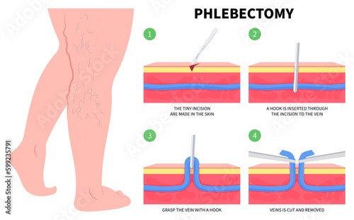 Limb Injury Phlebectomy Medical Anatomy of Vascular Artery Disease Varicose Vein Cramps or Endovenous Laser Venous and Valves Knee Heart Foot Calf Treat Flow Thigh Socks High Sores Aching photo