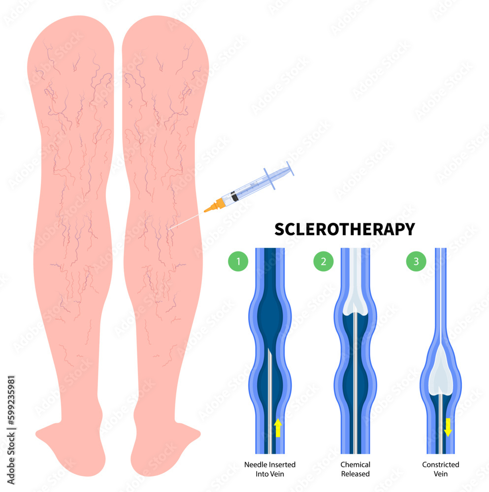 Foot Calf Aching Injury Treat Varicose Vein or Phlebectomy Artery
