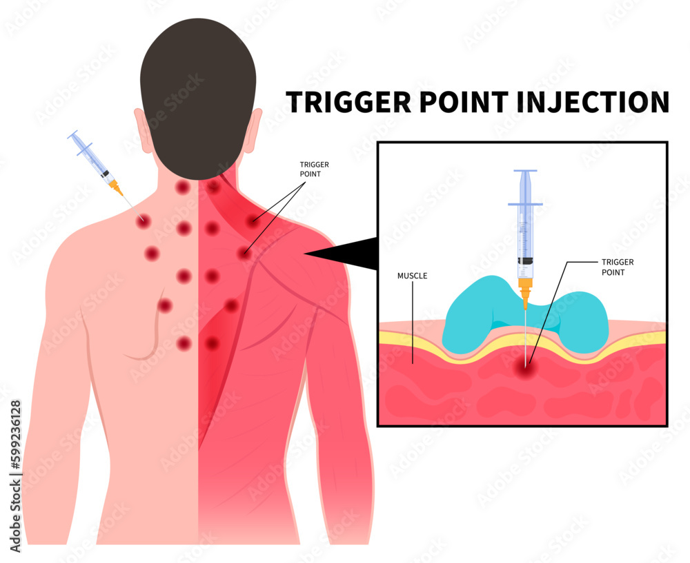 Fibromyalgia Trigger Points Image