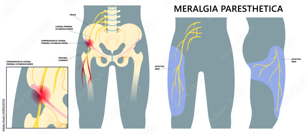 leg-injury-or-meralgia-paresthetica-and-it-band-syndrome-compressed