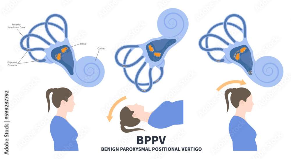 Semicircular Meniere’s Ear Canal Benign Paroxysmal Positional vertigo or BPPV loss balance dizzy Electronystagmography treat Canalith repositioning procedure otoconia calcium carbonate crystal brain - obrazy, fototapety, plakaty 