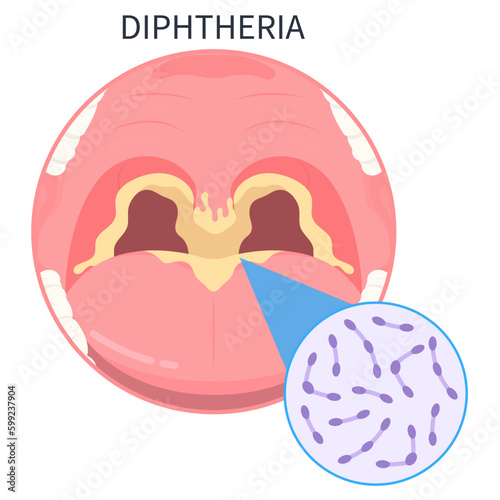 Diphtheria vaccine of group A with the tetanus croup strep throat bacterial photo