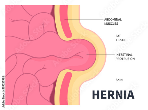 small large intestine constipation umbilical hernia or abdominal pain belly button inguinal incisional Femoral stomach diastasis recti ileus lump navel wall cavity baby infant birth volvulus Hiatus